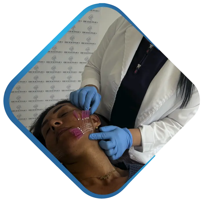 Hilos bioestimulación colágeno - Clínica Biodermo